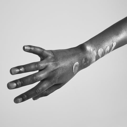DYSHIDROTIC ECZEMA